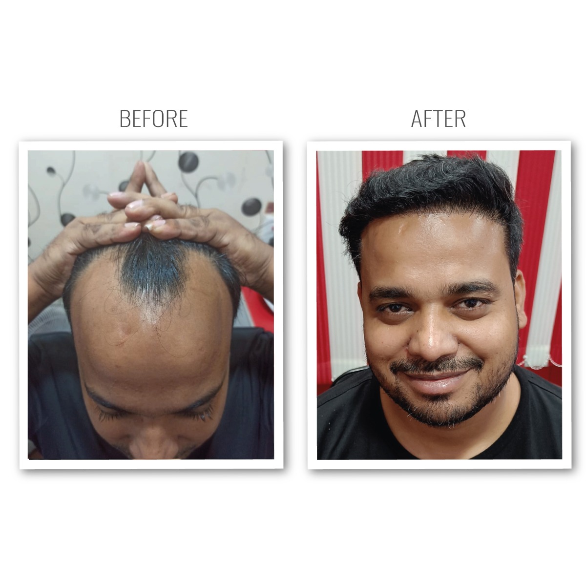 Hair Transplant Result - Hairline Restoration