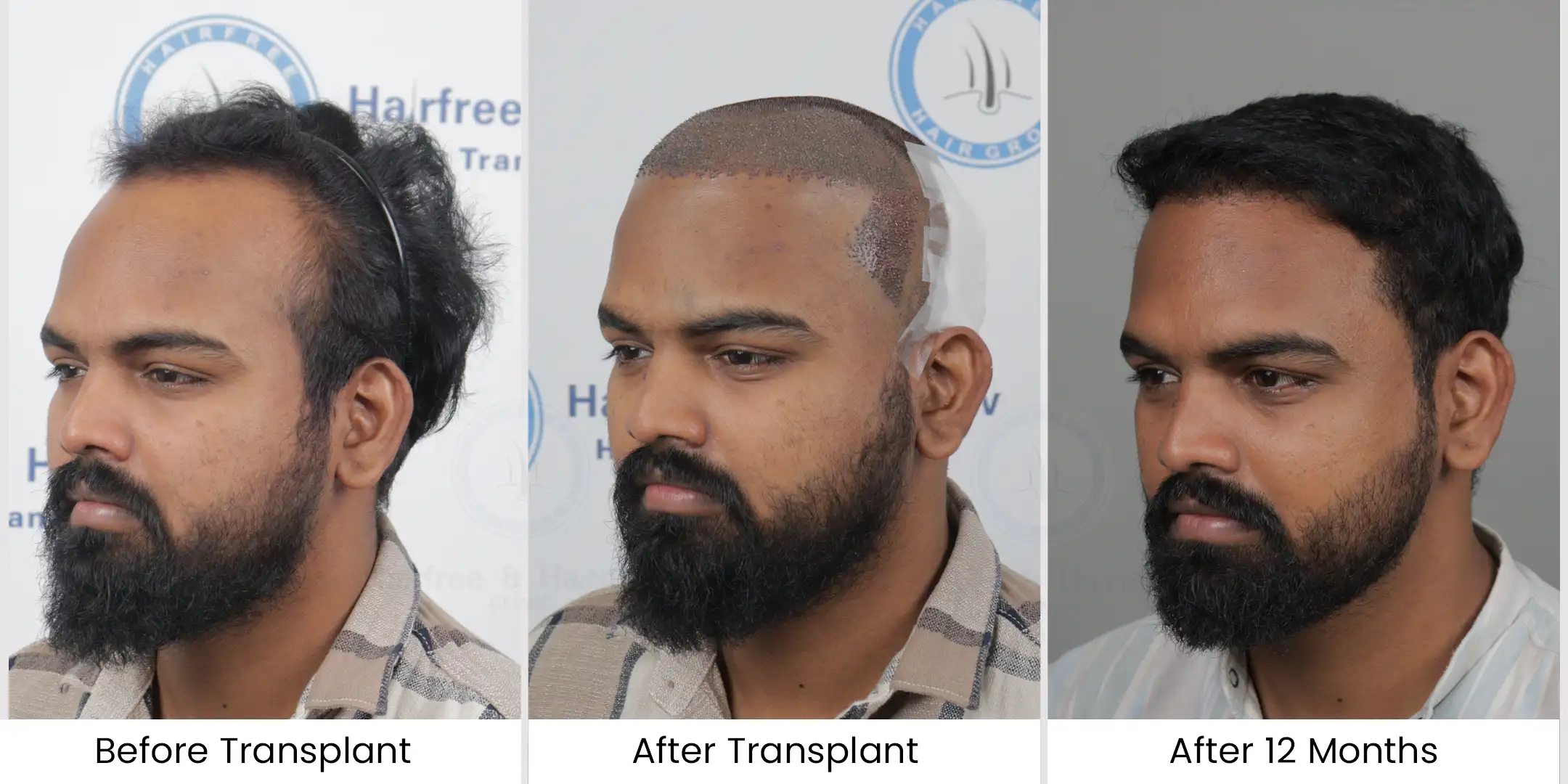 Hair Transplant Result - Full Density