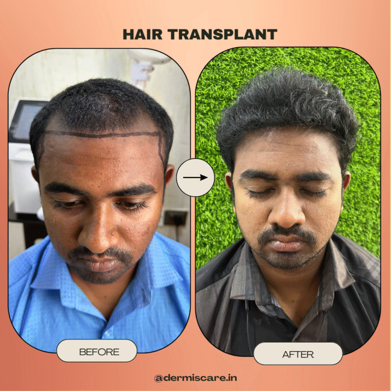 Hair Transplant Result - Crown Coverage