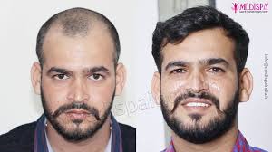 Hair Transplant Result - Natural Growth